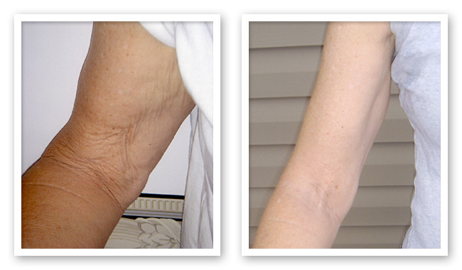  Sun Damaged Arms Before and After ThemaCell treatment
