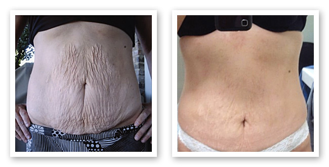 Waist and Belly Before and After ThemaCell treatment