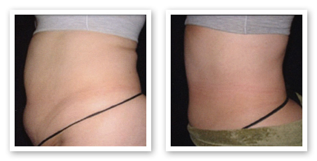 Non Invasive Lipo Proceedure - Before and After ThemaCell treatment