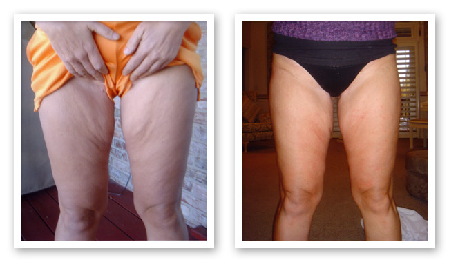 Thighs Before and After ThemaCell treatment